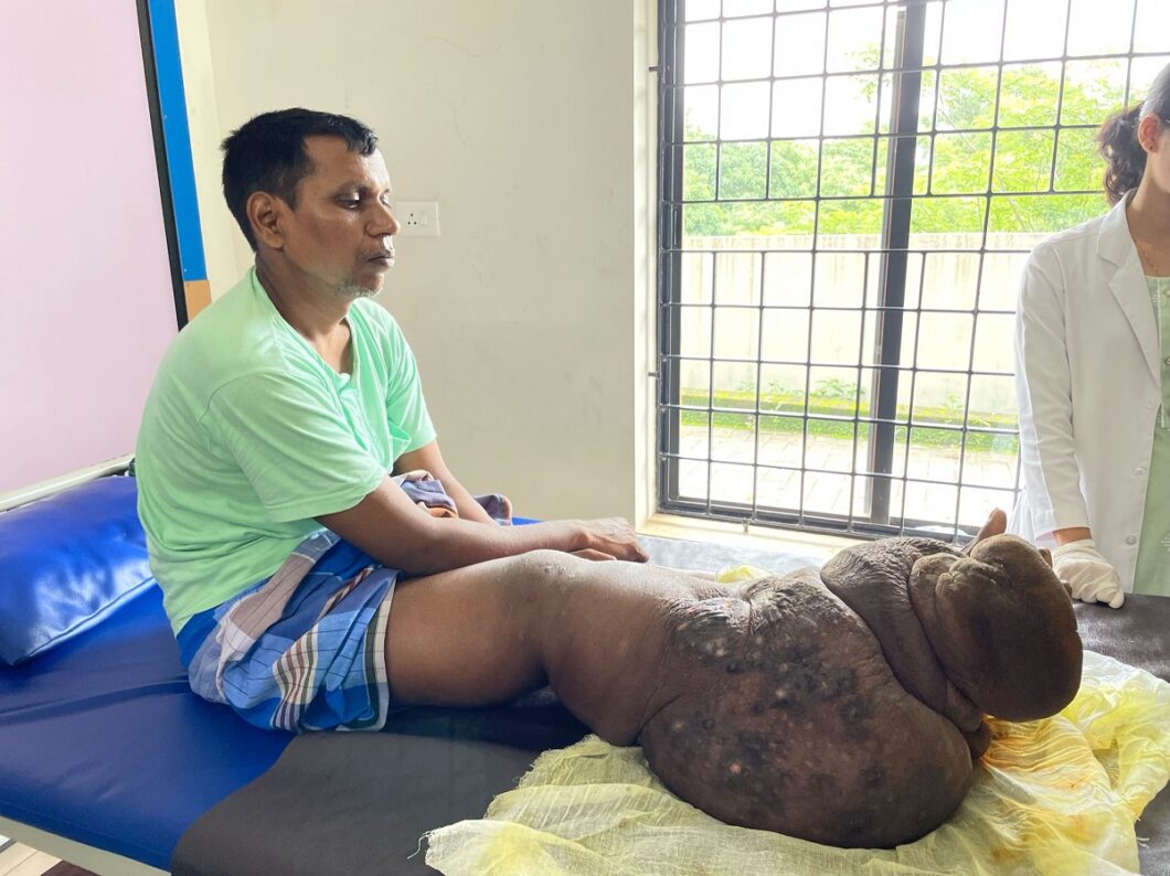 Männlicher Patient mit starkem Lymphödem und lymphatischer Filariose am Bein sitzt auf einem Behandlungstisch.
